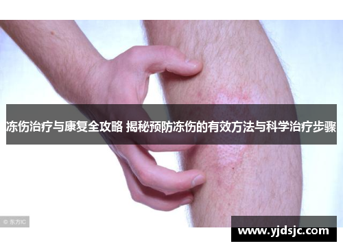 冻伤治疗与康复全攻略 揭秘预防冻伤的有效方法与科学治疗步骤